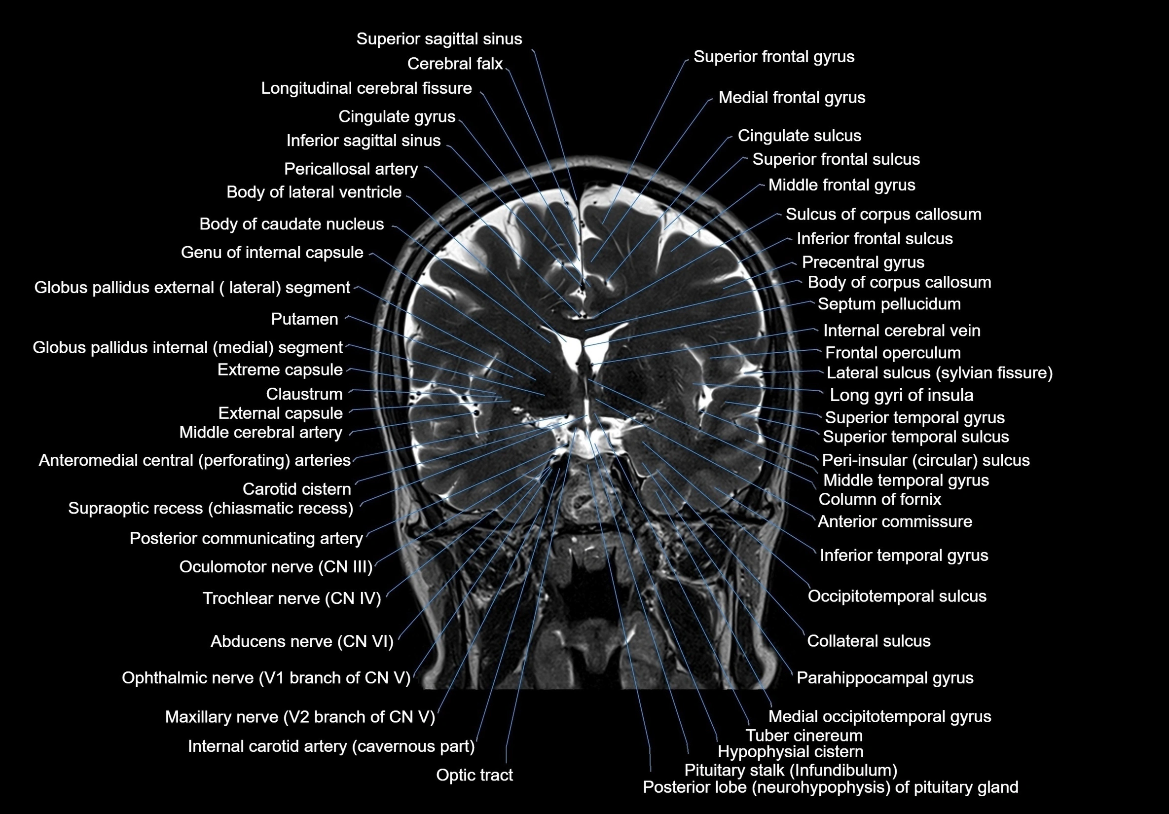 MRI Brain coronal cross sectional labelled anatomy 3T image  -img-00001-00033.webp